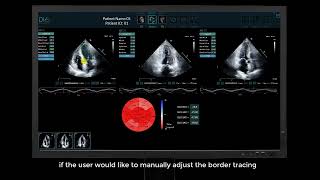 LVivo Seamless™-Enhance Your Echo Lab Workflow