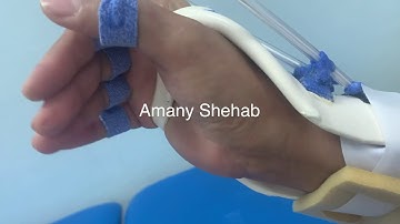 Dynamic Radial palsy splint