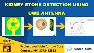 kidney stone detection using UWB Microstrip Antenna