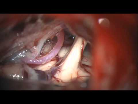 Trigeminal neuralgia decompression with audio