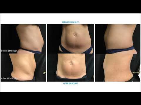 Emsculpt отзывы до и после EMSCULPT NEO ™ - The One in Body Shaping - YouTube