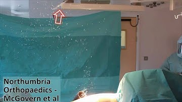 Influence of operating Lights on Laminar Airflow