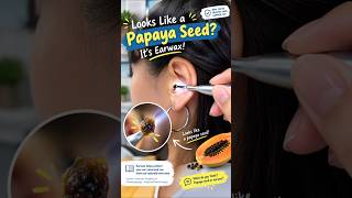 This Tiny Earwax Piece Looks Like a Papaya Seed… But Why? #shorts #earwax #earhealth This Tiny Earwax Piece Looks Like a Papaya Seed… But Why? #shorts #earwax #earhealth