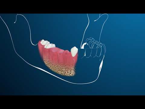 Videó: Mi az a fogászati sipoly?