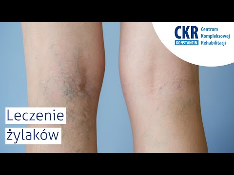 Wideo: Środki Ludowe Do Walki Z żylakami