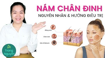 Nám chân đinh(chân sâu) là gì? Nguyên nhân và hướng điều trị hiệu quả