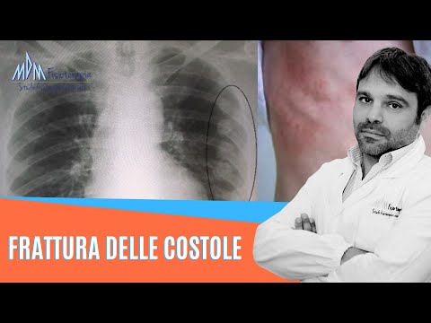 Video: Costole Contuse: Immagini, Sintomi, Trattamento, Tempo Di Guarigione E Altro