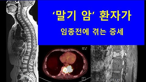 ‘말기 암’ 환자가 임종전에 겪는 증상