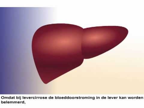 Levercirrose - Symptomen en behandeling