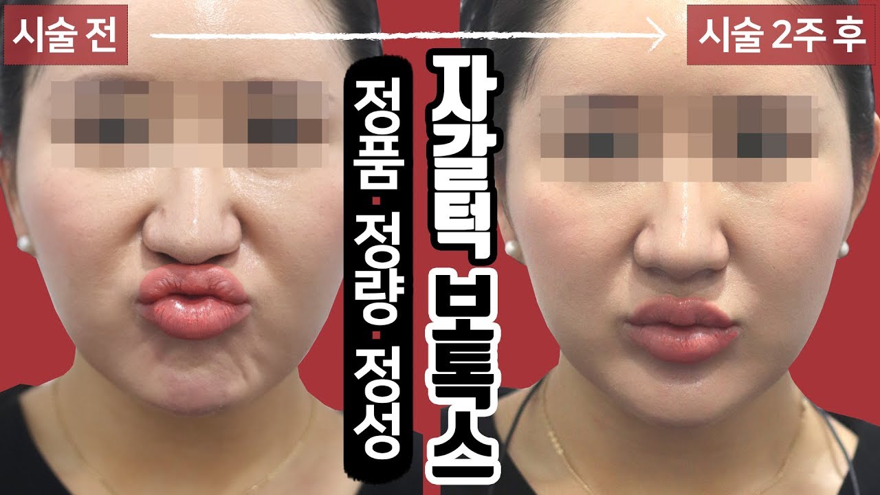 자갈턱보톡스 시술 영상 톡스앤필 천안신부점 북면 피부과, 보톡스 - YouTube