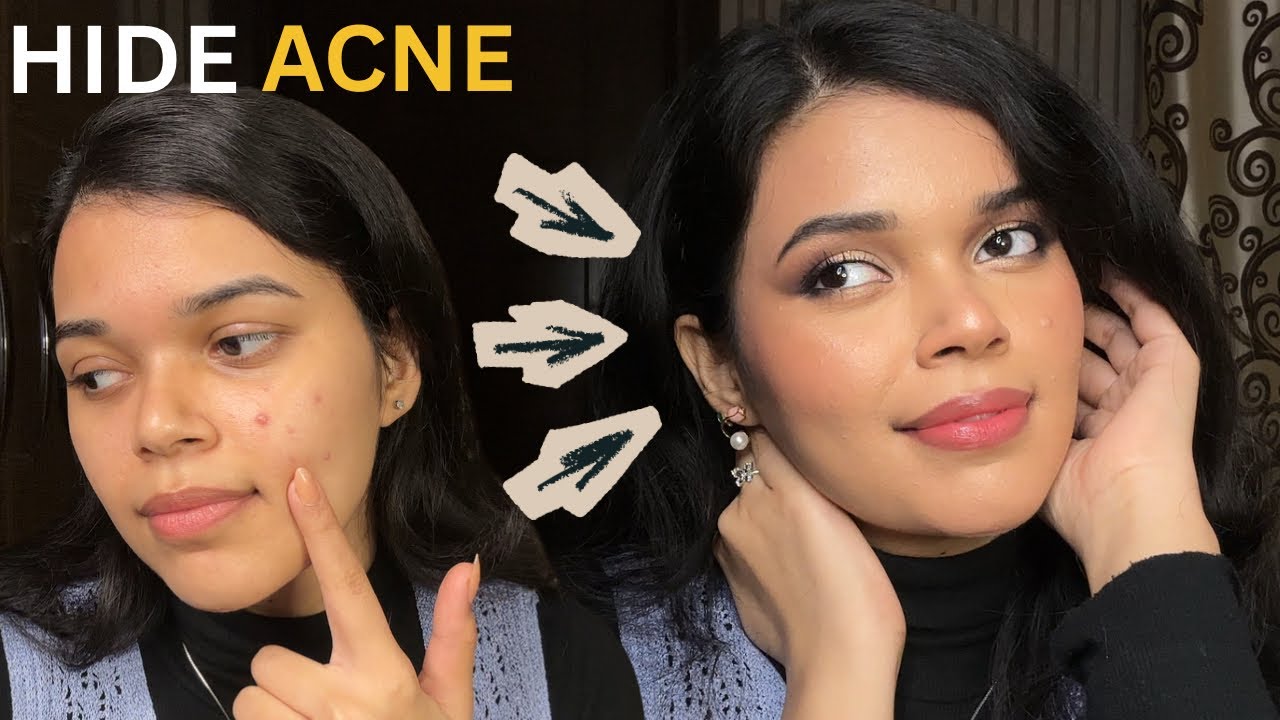 How to Hide Acne, Pimples & Acne Marks  | Flawless Skin Makeup Hack ✨