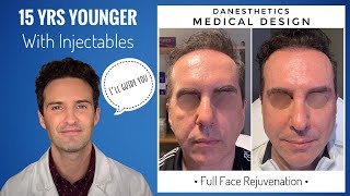 Male Full Face Rejuvenation: Fillers