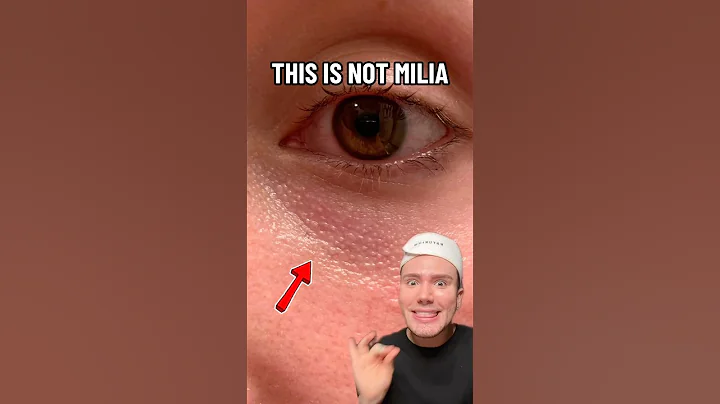 HOW TO GET RID OF EYE BUMPS!😱 (follow for more!💗) #skincare #skincareroutine #skin #eyes #beauty