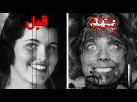 فيديو: من كان رائدا في الجراحة النفسية مع شق الفص الجبهي؟