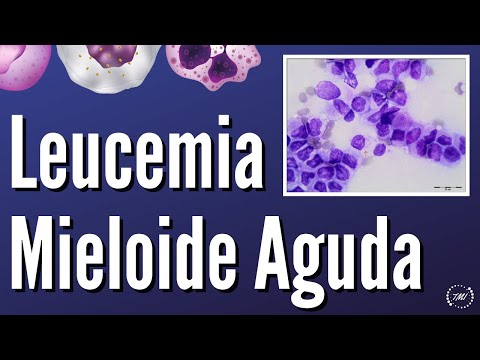 Leucemia Mieloide Aguda | 2021