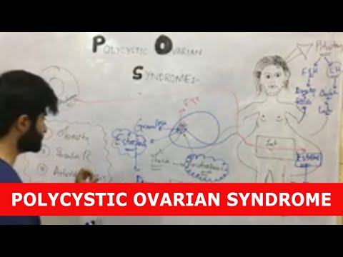 Polycystic Ovarian Syndrome (PCOS) | Pathology, Signs and Symptoms, Risk Factors -Pathology Lecture