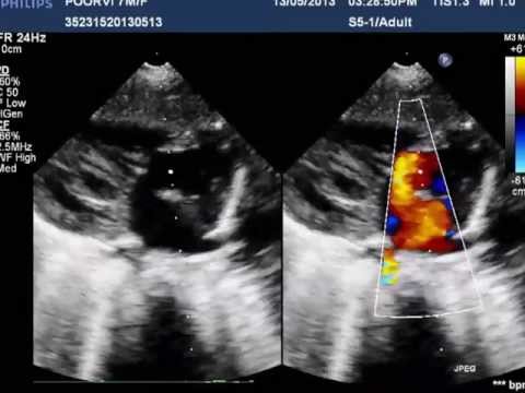 Mirror image dextrocardia