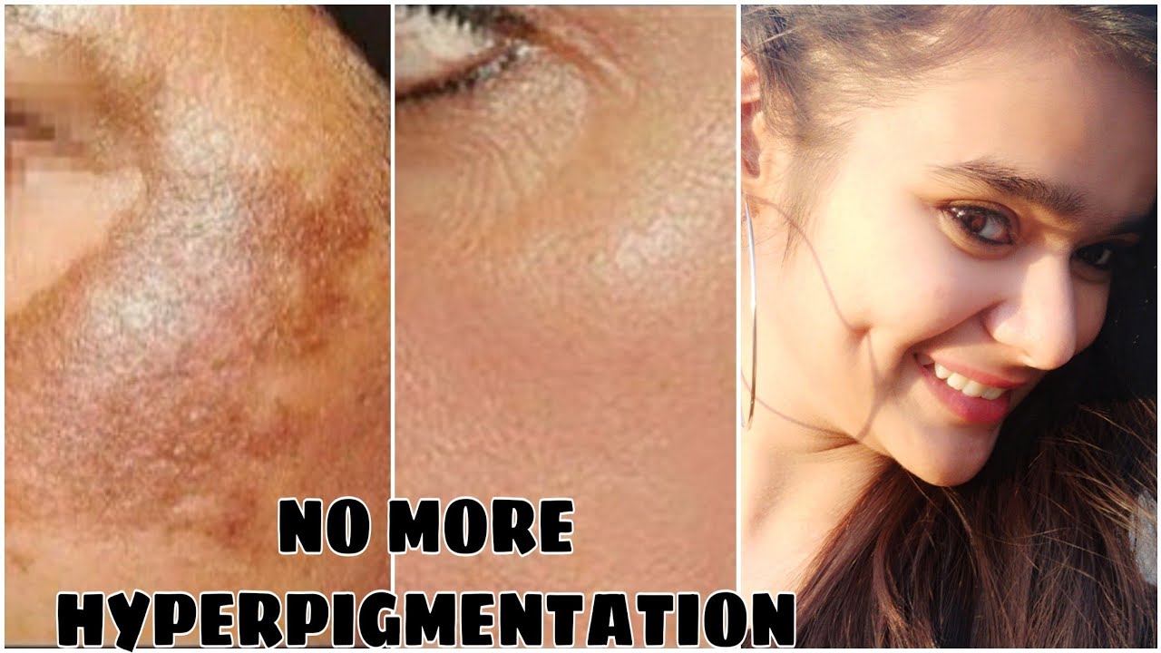 how-to-get-rid-of-hyper-pigmentation-in-hindi-hyper-pigmentation