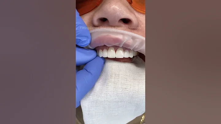 A combination of porcelain bridges & veneers to replace missing teeth & create a wider smile 🤍