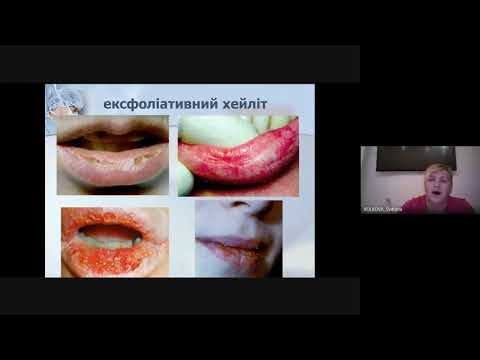 Захворювання губ і язика у дітей різного віку