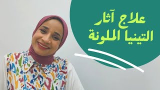 علاج اثار التينيا الملونة | ازالة البقع | توحيد لون الجسم