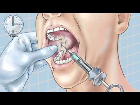 Standard Inferior Alveolar Nerve Block