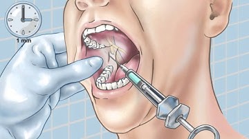 Standard Inferior Alveolar Nerve Block