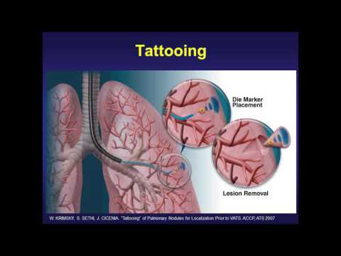 Upper GI Endoscopy Procedure in the ED. 