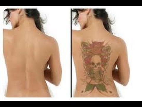 Tattoo Removal Boston MA - 7 Things You Should Know Before 