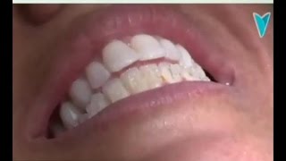 Clínica dental Cuevas Queipo - Ronquido y apnea del sueño