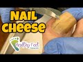 CUTTING NAILS with TOE CHEESE!