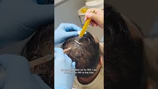 Hair loss was affecting his confidence, but the right treatment plan made all the difference.