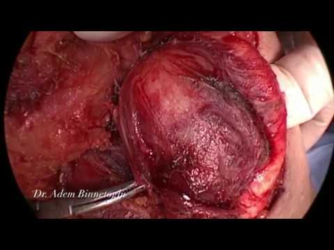 Video: Lub Plawv Thiab Carotid Artery Tumors Hauv Cats