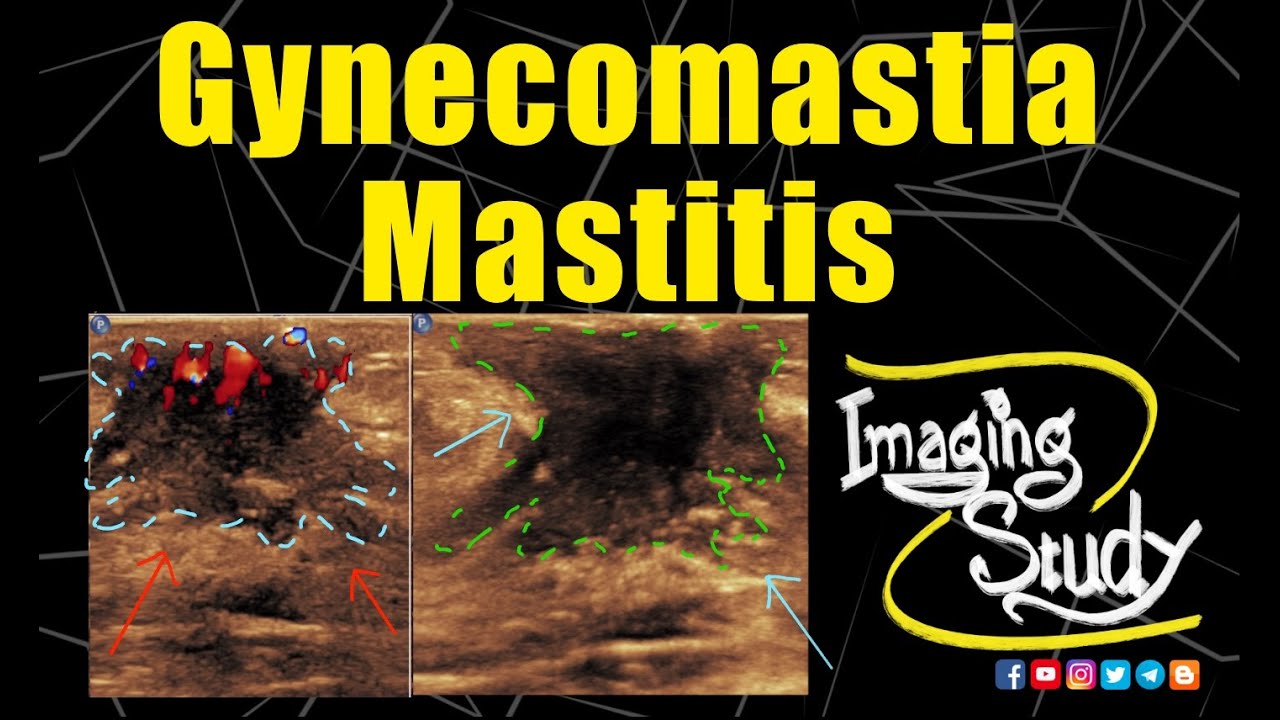 Gynecomastia With Mastitis Ultrasound Doppler Case 232 Youtube