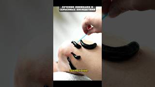 Лечение пиявками, какие будут последствия #здоровье #медицина