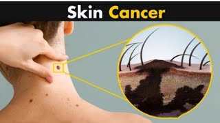 What Happens in Skin Cancer|Symptoms, Causes and Treatment (Urdu/Hindi)skincancer melanoma