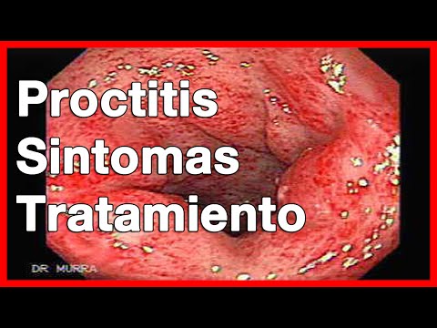 Vídeo: Proctitis Rectal: Síntomas, Tratamiento Con Remedios Caseros