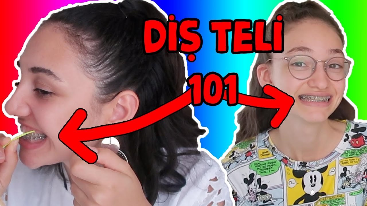 DİŞ TELLERİ HAKINDA HER ŞEY! Ücretler, Süreç, Acıyor mu, Yemek Yeniyor mu?