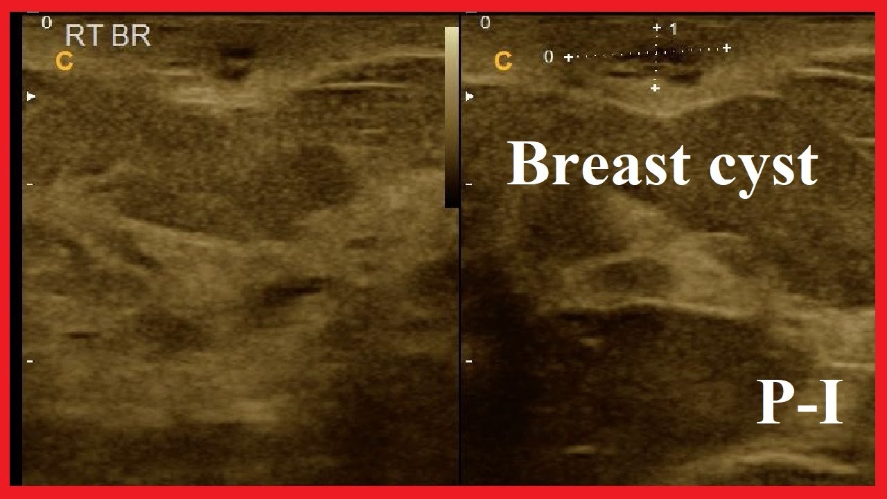 Breast cyst Infected subareolar cyst in right breast Amader