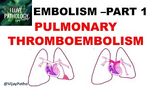 EMBOLISM Part 1: Pulmonary &  Systemic thromboembolism