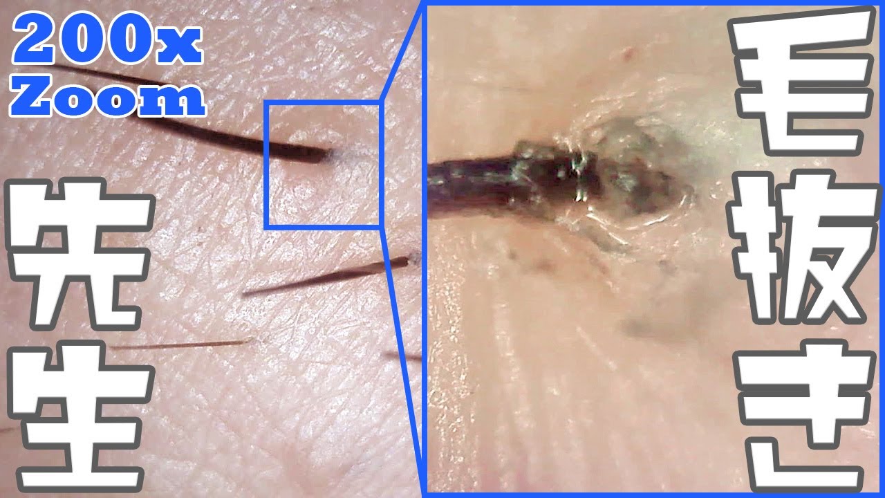 Dr.Gavel 【値下げしました】更に値下げしました 044 200x Zoom Pull out the beard slowly Dr. tweezers - YouTube
