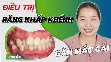 Cận cảnh toàn bộ quá trình gắn mắc cài điều trị răng khấp khểnh, lệch lạc