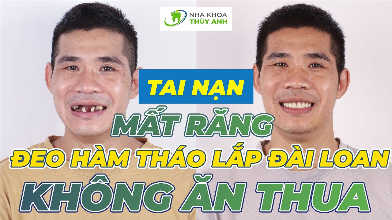 LÊN KẾ HOẠCH TRỒNG LẠI TOÀN BỘ RĂNG CHO ANH THANH NIÊN MẤT GẦN HẾT RĂNG ...