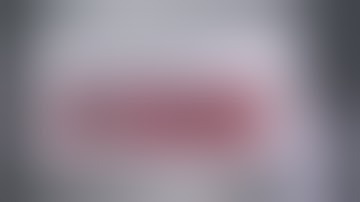 A Modified VATS Procedure for Treating Adult Intralobar Pulmonary Sequestration