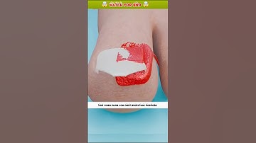 Truth About Ingrown Nails: Explained in 3D Animation #shorts #animation