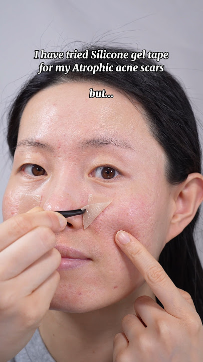 Silicone gel tape working for Atrophic acne scars❓#acnescars #acne #scars