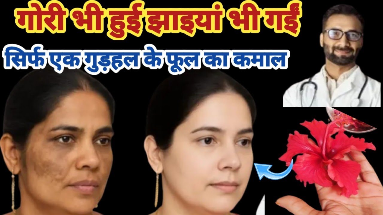 एक गुड़हल के फूल का ऐसा जादुई यूज़ देख कर आपभी चौंक जाएंगे 4 दिन में मेरी झाइयां ? tips and tricks