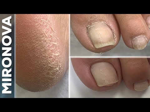 Hyperkeratosis / Overgrown hyponychium / Treatment feet from help hybrid diatwisters Busch