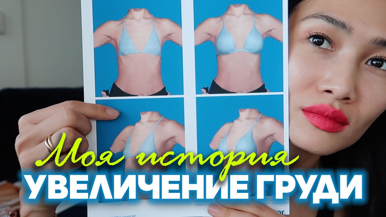УВЕЛИЧЕНИЕ ГРУДИ - сколько стоит? как выбрать доктора? как подобрать ...