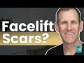Do Facelifts Leave Scars How To Minimize Facelift Incisions Heal Flawlessly 